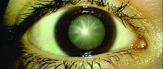 Afectiunile anexe oculare in diabetul zaharat