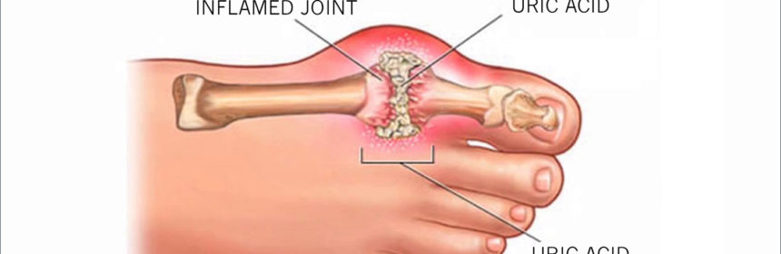 cum să alinați umflarea articulației genunchiului
