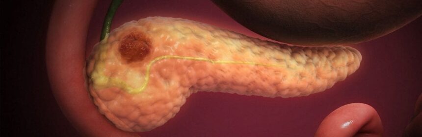 Simptome in cancerul de pancreas